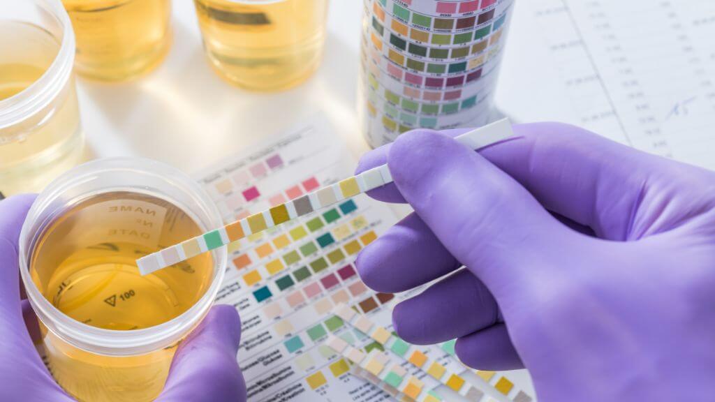 testing sugar level using urine